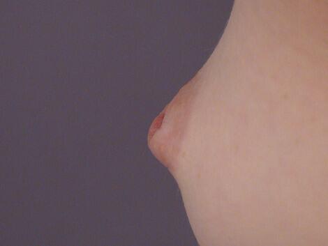 Nipple - Inversion Correction Before & After Image