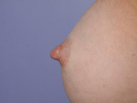 Nipple - Inversion Correction Before & After Image