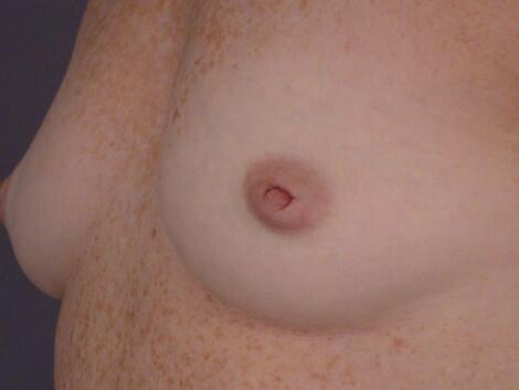 Nipple - Inversion Correction Before & After Image