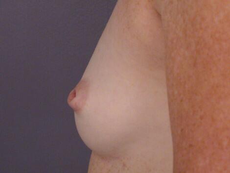 Nipple - Inversion Correction Before & After Image