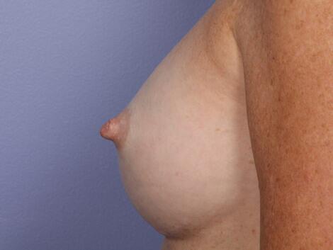 Nipple - Inversion Correction Before & After Image