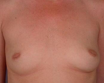 Nipple - Inversion Correction Before & After Image