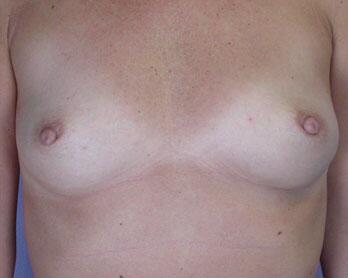 Nipple - Inversion Correction Before & After Image