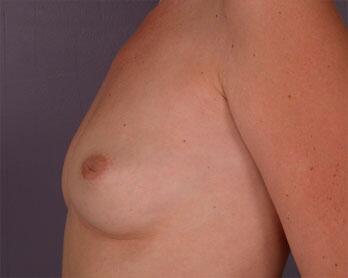 Nipple - Inversion Correction Before & After Image