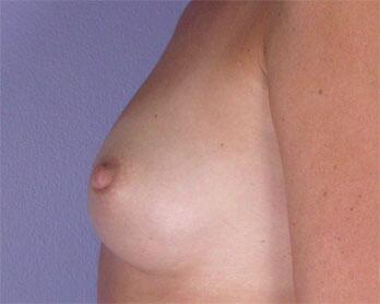 Nipple - Inversion Correction Before & After Image