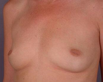 Nipple - Inversion Correction Before & After Image