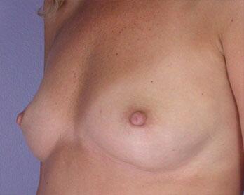 Nipple - Inversion Correction Before & After Image