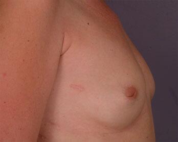 Nipple - Inversion Correction Before & After Image