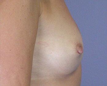 Nipple - Inversion Correction Before & After Image