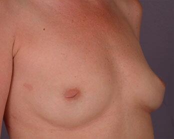 Nipple - Inversion Correction Before & After Image