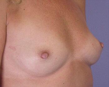 Nipple - Inversion Correction Before & After Image