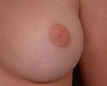 Nipple - Inversion Correction Before & After Image