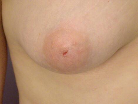 Nipple - Inversion Correction Before & After Image