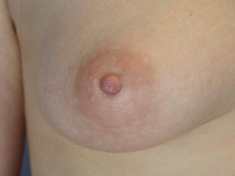 Nipple - Inversion Correction Before & After Image