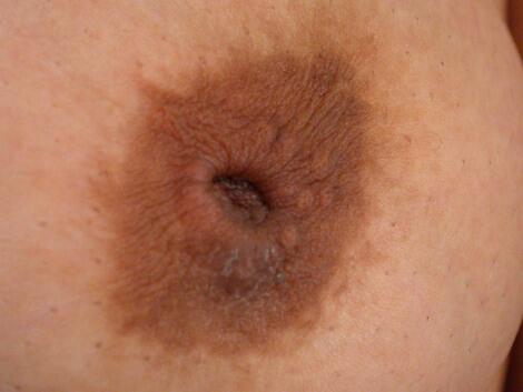 Nipple - Inversion Correction Before & After Image