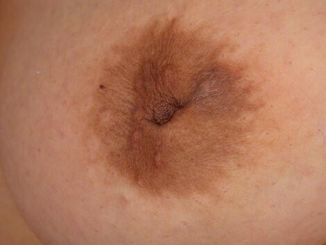 Nipple - Inversion Correction Before & After Image