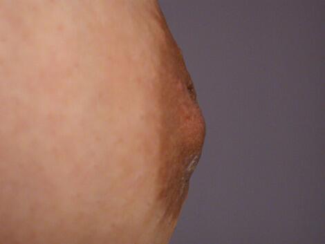 Nipple - Inversion Correction Before & After Image