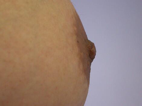 Nipple - Inversion Correction Before & After Image