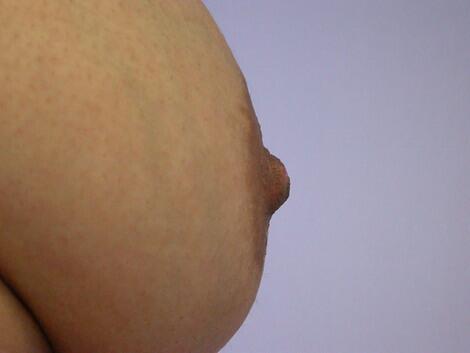 Nipple - Inversion Correction Before & After Image