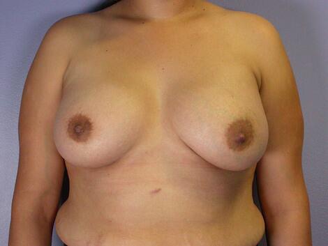 Nipple - Inversion Correction Before & After Image