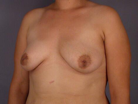 Nipple - Inversion Correction Before & After Image