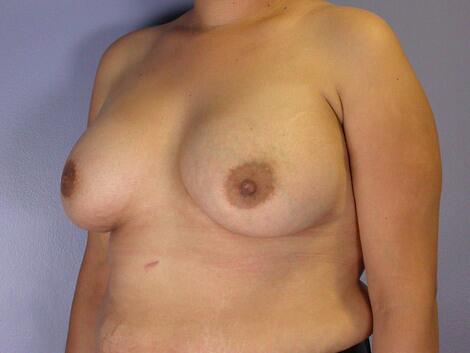 Nipple - Inversion Correction Before & After Image