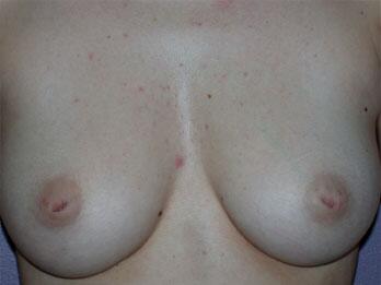 Nipple - Inversion Correction Before & After Image