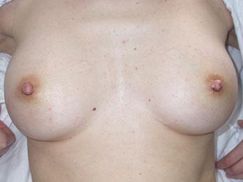 Nipple - Inversion Correction Before & After Image