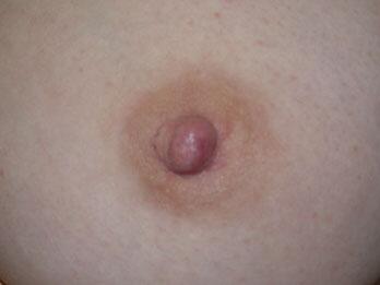 Nipple - Inversion Correction Before & After Image