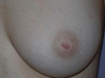 Nipple - Inversion Correction Before & After Image