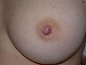 Nipple - Inversion Correction Before & After Image