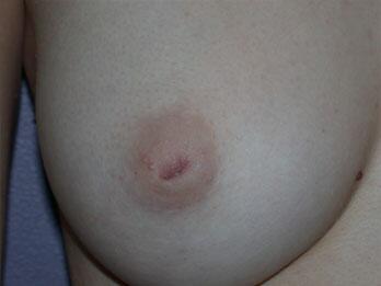 Nipple - Inversion Correction Before & After Image