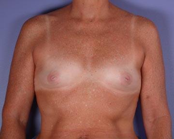 Nipple - Inversion Correction Before & After Image