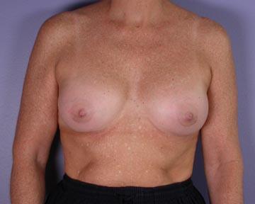 Nipple - Inversion Correction Before & After Image