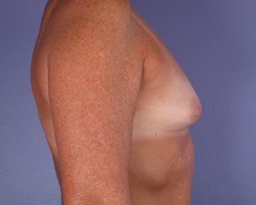 Nipple - Inversion Correction Before & After Image