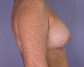 Nipple - Inversion Correction Before & After Image