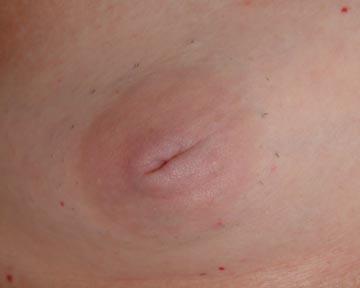 Nipple - Inversion Correction Before & After Image