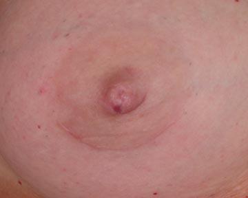 Nipple - Inversion Correction Before & After Image