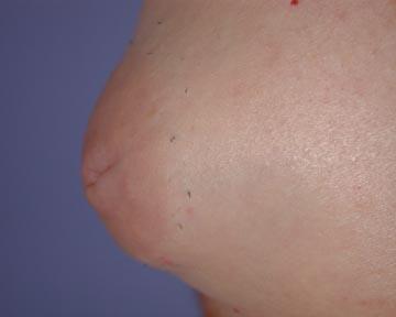 Nipple - Inversion Correction Before & After Image