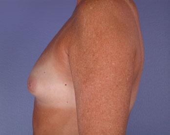 Nipple - Inversion Correction Before & After Image