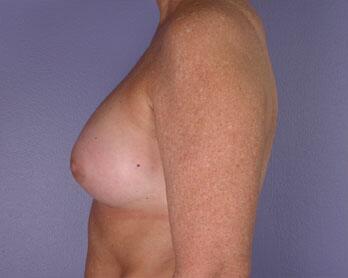 Nipple - Inversion Correction Before & After Image