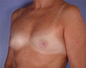 Nipple - Inversion Correction Before & After Image