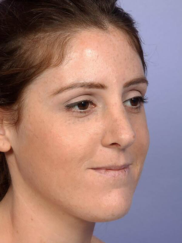 Rhinoplasty Before & After Image