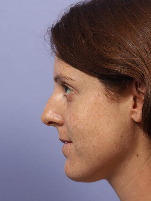 Rhinoplasty Before & After Image