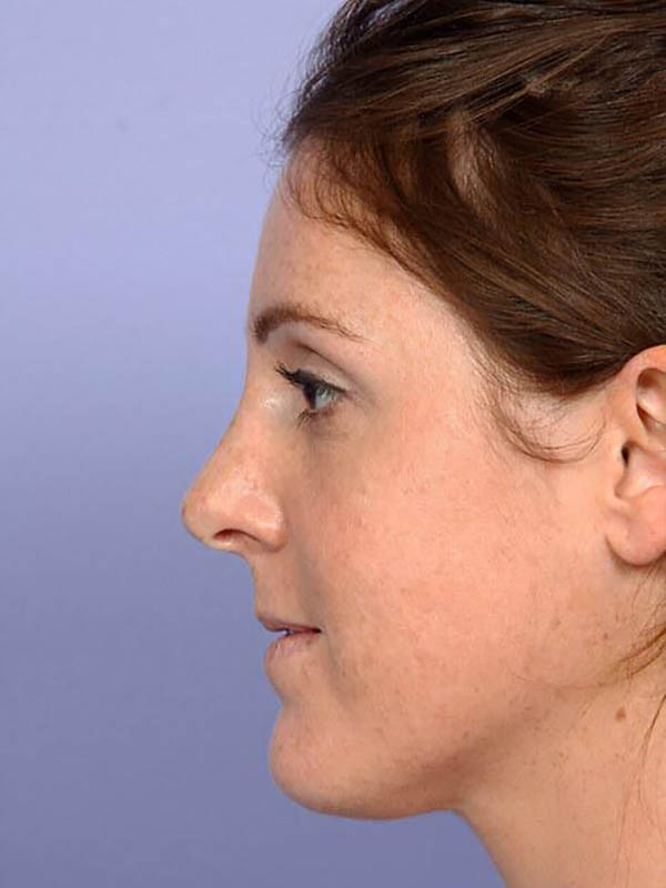 Rhinoplasty Before & After Image