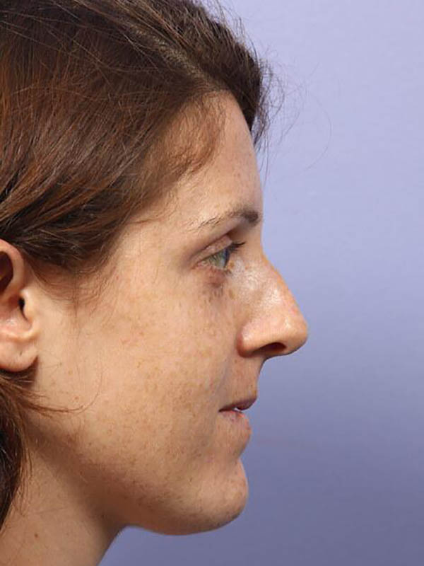 Rhinoplasty Before & After Image