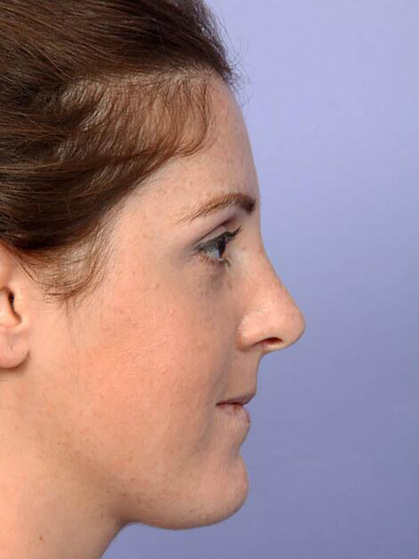 Rhinoplasty Before & After Image