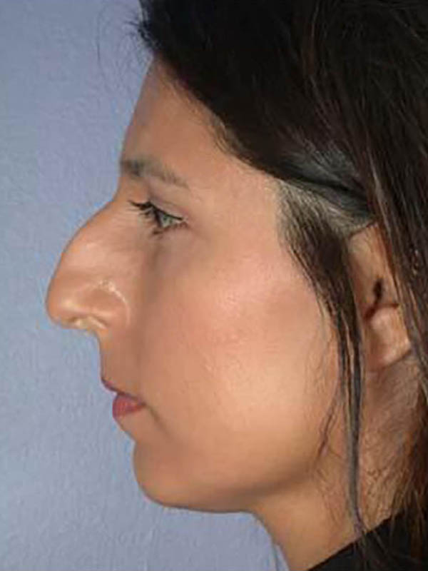 Rhinoplasty Before & After Image