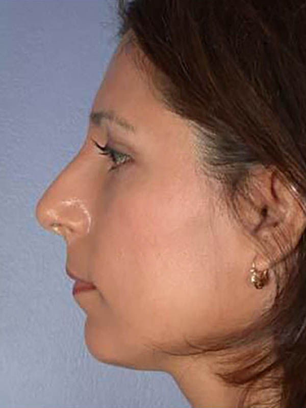 Rhinoplasty Before & After Image