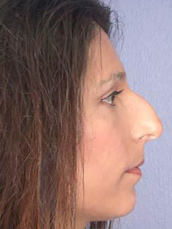 Rhinoplasty Before & After Image